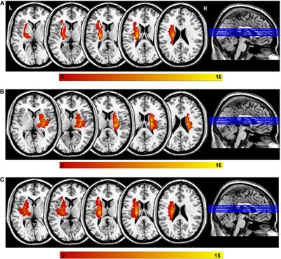 Altered cerebellar functional connectivity in chronic subcortical stroke patients